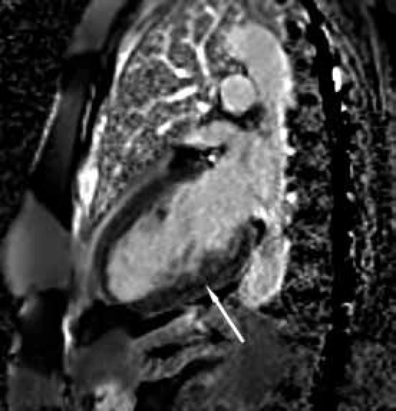 Zobrazení magnetickou rezonancí
Rozvláknění spodní stěny po aplikaci kontrastní látky.