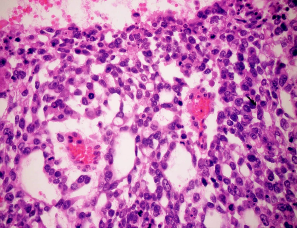 Charakteristické Schillerové-Duvalové telieska v hepatálnom YST (HE, zväčšenie 600x)