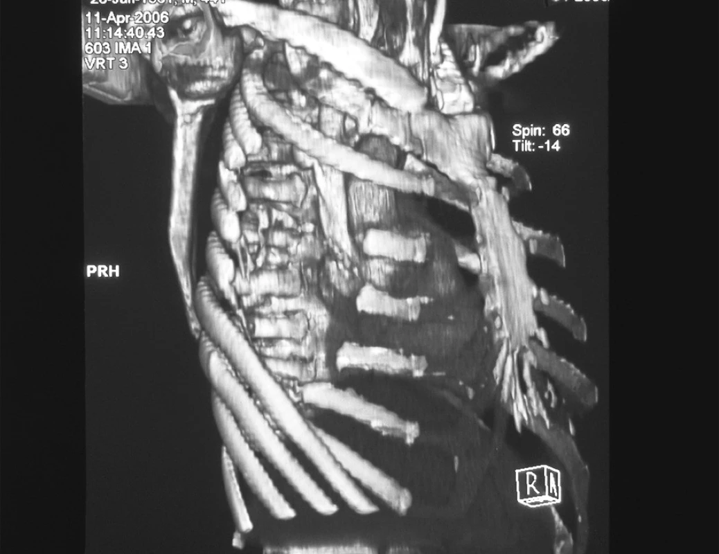 CT obraz 3D rekonštrukcie, stav po torakoplastike
Fig. 5. A CT view of the 3D reconstruction, thoracoplasty completed