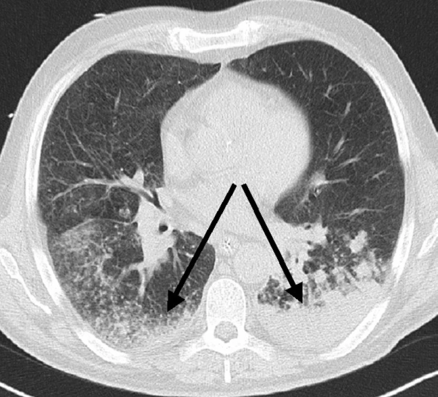 CT scan, patrná postupná konsolidace bazálních oblastí plic a ústup drobnoložiskového nálezu, 8. den
Fig. 2. CT scan, gradual consolidation of the basal pulmonary regions and recovery of the small opacities findings – Day 8