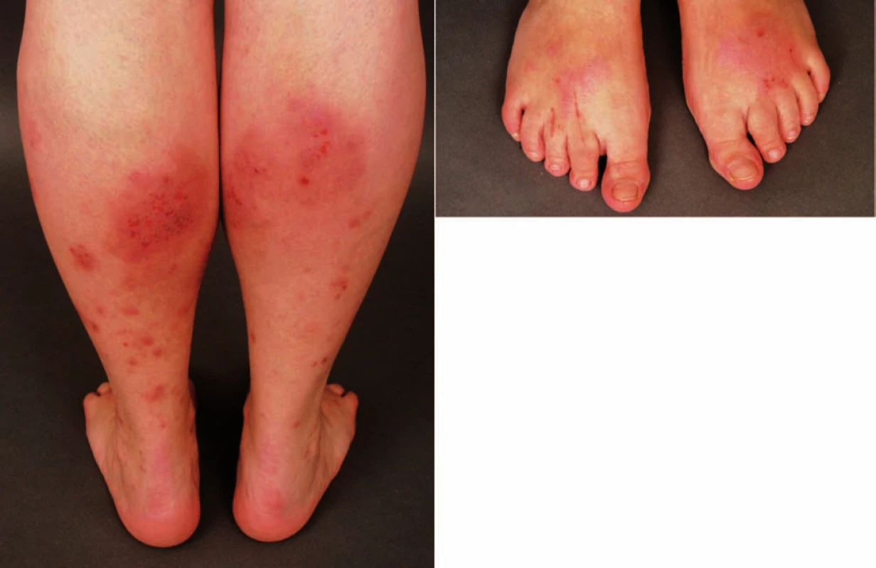 Eczema contactum – chrom (pracovní obuv)