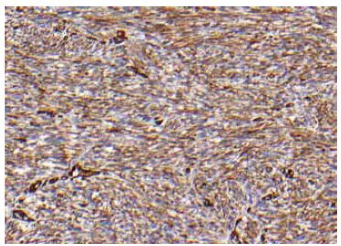 Histologický nález, imunohistochemické barvení na vimentin, zvětšení 20krát.