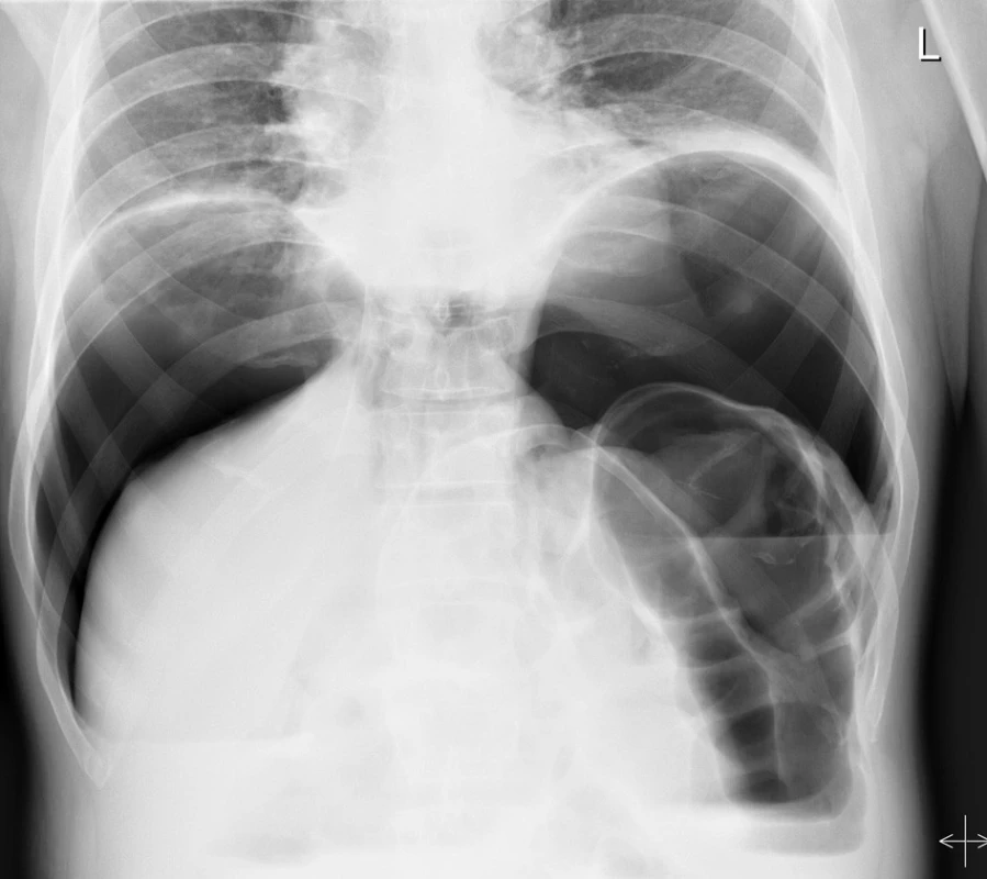 Nativní RTG snímek břicha: pneumoperitoneum u nemocného s akutní perforovanou divertikulitidou sigmatu