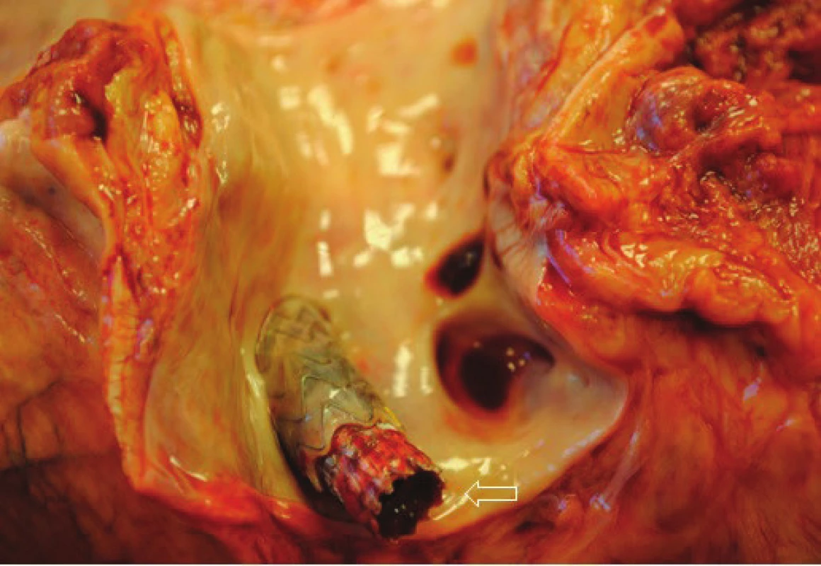 Sekční nález. − průchodný TIPS v portálním řečišti
Fig. 6: Autopsy fading − unobstructed TIPS in portal venous system