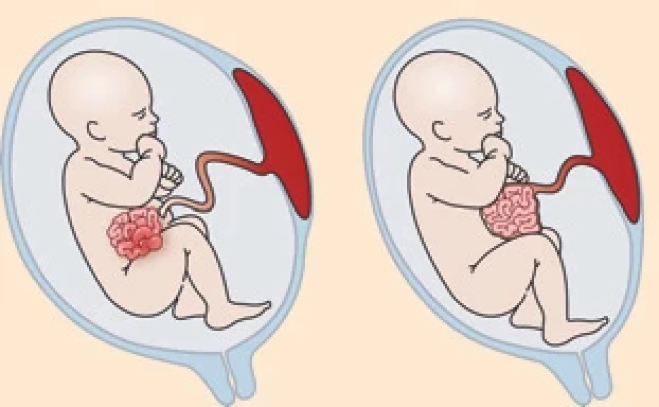 Charakteristika komplexní gastroschízy (nález polyhydramnia, dilatace střevních kliček) a omfalokély (umbilikální defekt).