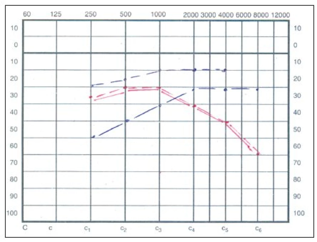 Audiogram – prevodová porucha sluchu vľavo.