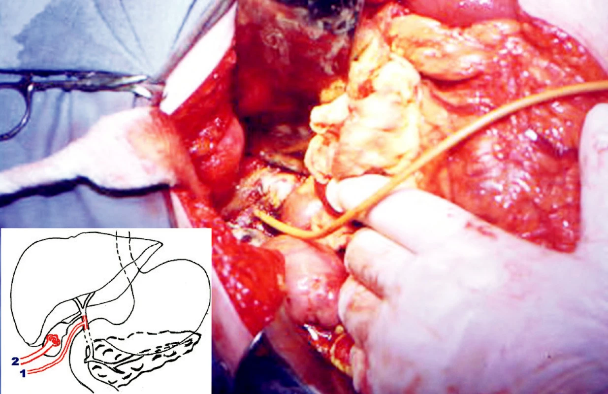 Vložený Kehrov T-drén do ductus choledochus cez perforačný otvor – peroperačný pohľad 
Schématický nákres chirurgického riešenia spontánnej ruptúry ductus choledochus
1. Kehrov T-drén v d. choledochus, 2. Malecotov katéter v cholecyste 
Pic. 1. Inserted Kehr T drain into ductus choledochus through  perforation – peroperative view
Schematic layout of surgical treatment of spontaneous rupture of ductus choledochus
1. Kehr T drain 2. Malecot catheter in gall bladder 
