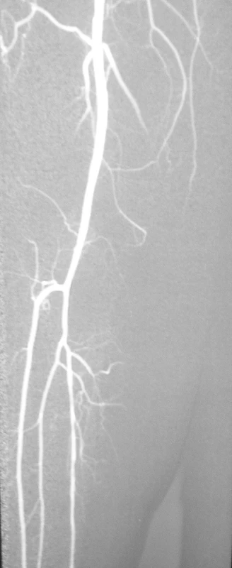 Digitálna subtrakčná angiografia po vykonaní perkutánnej transluminálnej angioplatiky arteria poplitea a tractus tibiofibularis na pravej dolnej končatine s výborným efektom
Fig. 3. Digital subtraction angiography following percutaneous angioplasty of the popliteal artery and the tibiofibular tract on the right lower extremity, with excellent outcome