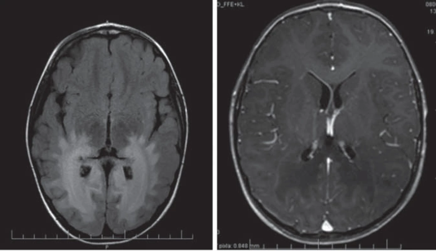 Detská cerebrálna forma X-ALD, 4,5-ročný chlapec.
Obr. 1a) T1WI – hypointenzívny signál temporo-okcipitálne obojstranne.
Obr. 1b) T2WI – symetrické splývavé lézie hyperintenzívneho signálu temporo-okcipitálne periventrikulárne a lobárne s postihnutím thalamov a BG obojstranne. 
Obr. 1c) FLAIR – hyperintenzívny signál splývaného charakteru (to isté dieťa).
Obr. 1d) T1WI + kontrast – hypointenzívny signál temporo-okcipitálne obojstranne s kontrastnou líniou.