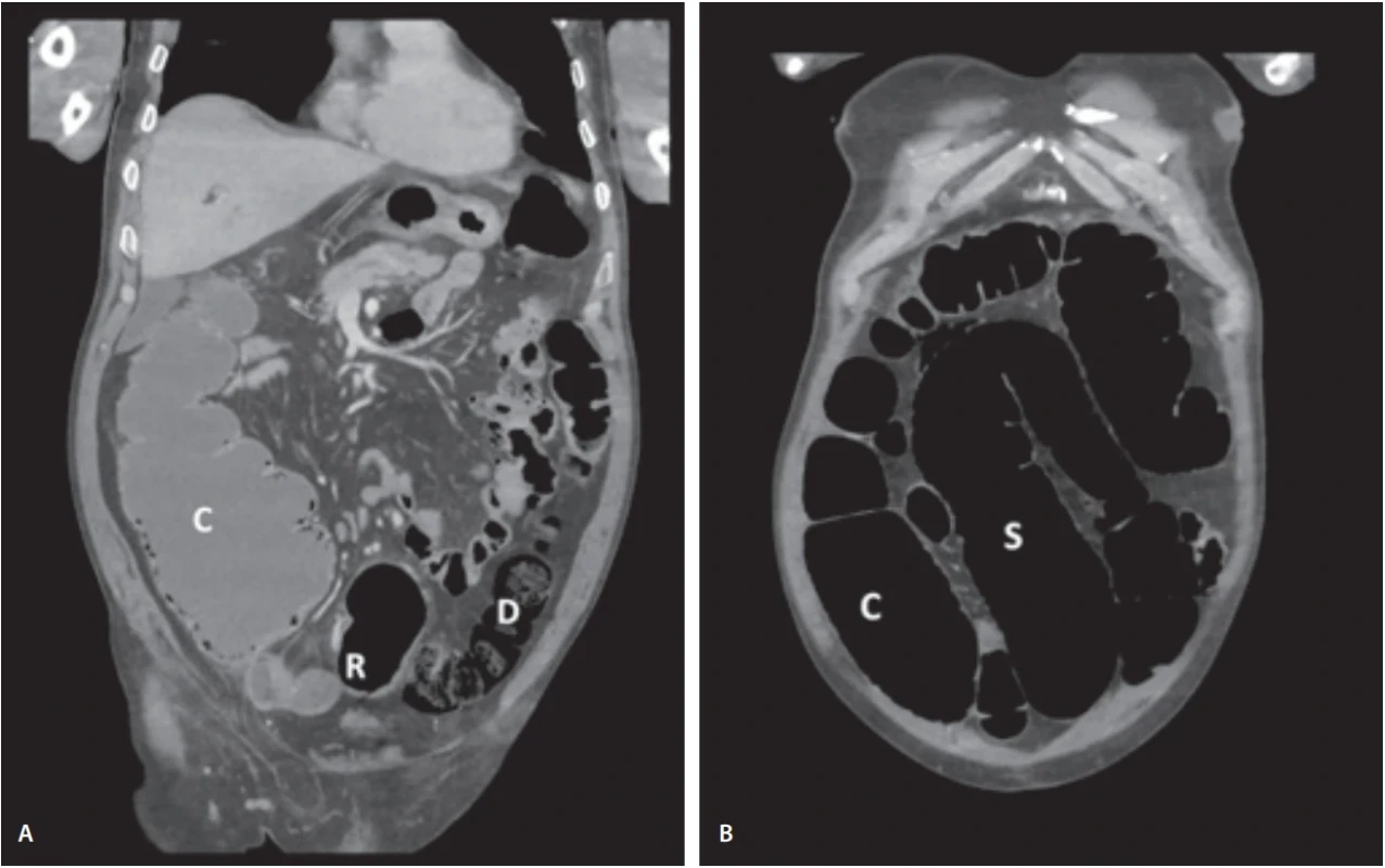 Fig. 1. Postcontrast CT scan with a reconstruction of 3mm layers in the coronal plane. (A) Signifi cant dilatation of the caecum with a fl uid content. (B) Dilatation of the caecum and colon sigmoideum.. Obr. 1. CT vyšetření po podání kontrastní látky s rekonstrukcí v 3mm vrstvách v koronální rovině. (A) Výrazná dilatace slepého střeva s obsahem tekutiny. (B) Dilatace slepého střeva a sigmatu.