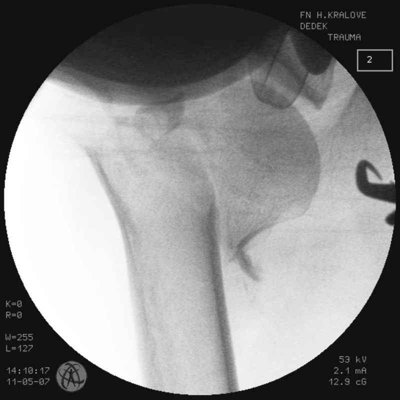 RTG obraz dislokované zlomeniny proximálního humeru u pacienta č. 2
Fig. 4. X-ray view of the dislocated proximal humeral fracture in a patient No. 2