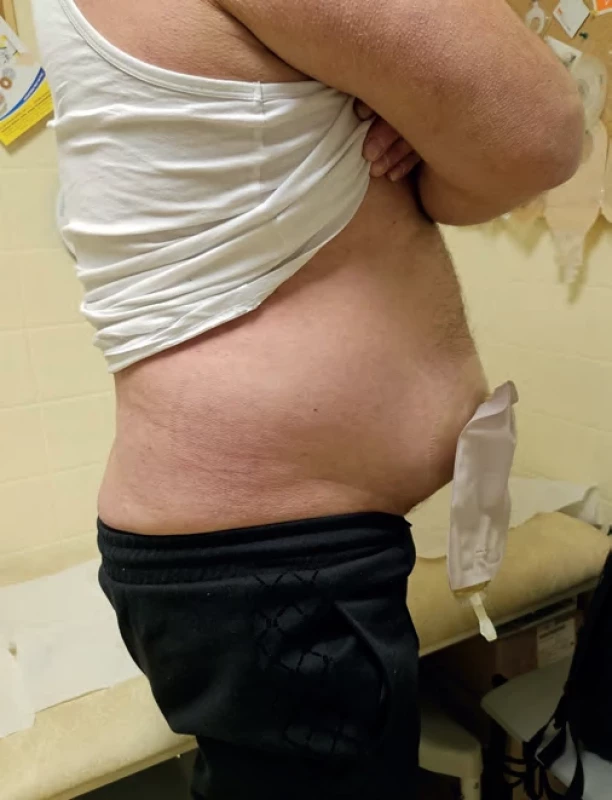 Pacient s parastomální hernií po otevřené radikální cystektomii s použitím ileálního konduitu. Fig. 1. Patient with parastomal hernia following open radical cystectomy with ileal conduit.