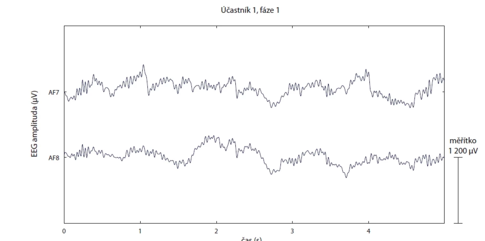 Účastník 1, fáze 1, hrubá data ze dvou elektrod (AF7, AF8), prvních 5 s signálu, provedena korekce baseline, fi ltrace pásmovou propustí 0,1–30 Hz, signál má větší amplitudu než je amplituda očekávaná. </br>Fig. 6. Participant 1, phase 1, raw data from two electrodes (AF7, AF8), fi rst 5 sec of the signal, baseline correction performed, bandpass fi ltering 0.1–30 Hz, the signal has a larger amplitude than expected.