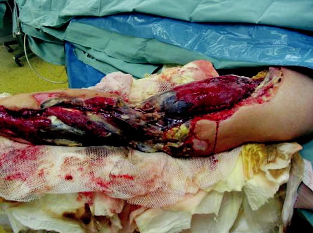 Left upper extremity eighth day after the injury