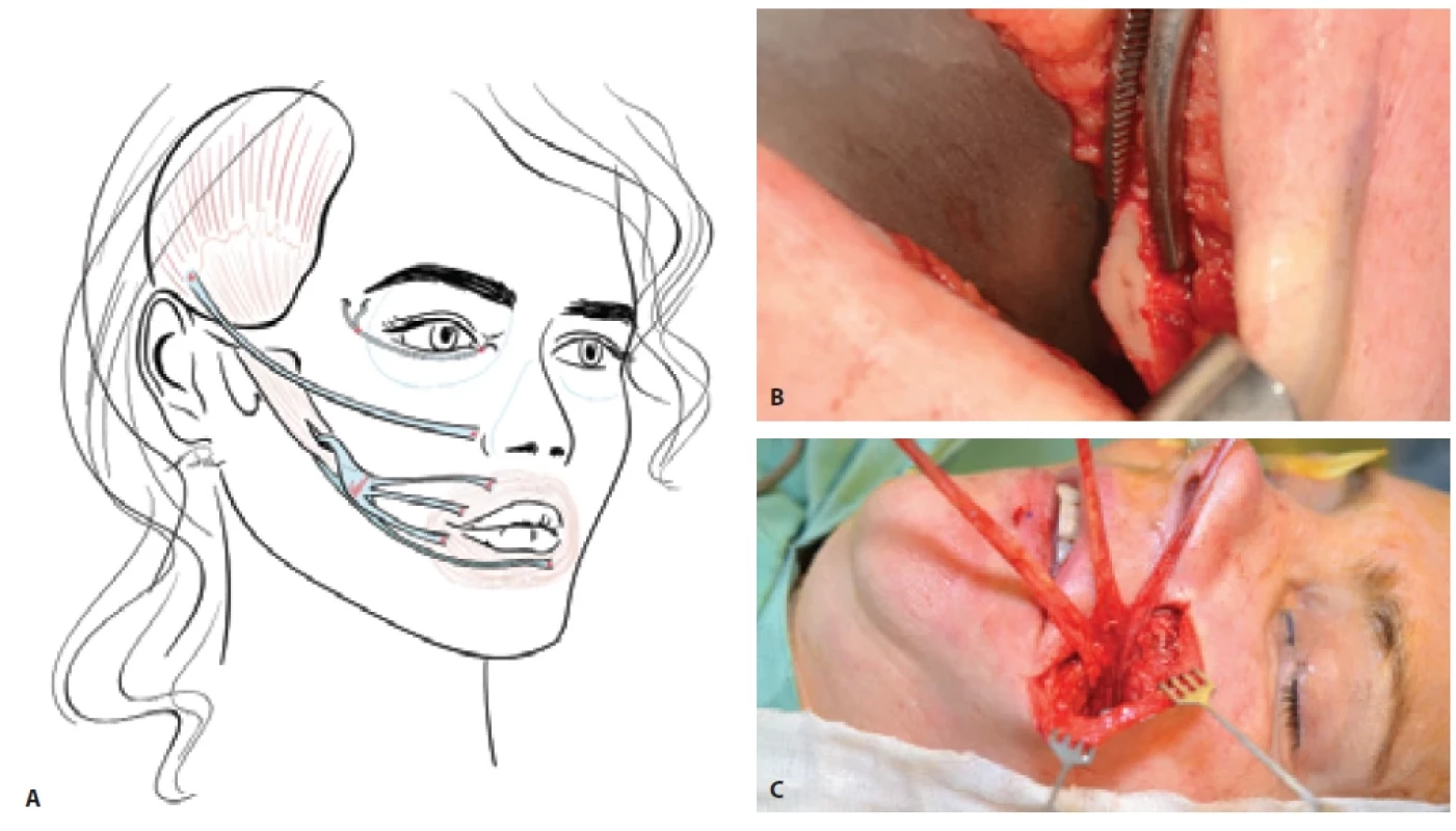 Minimally invasive temporalis tendon transfer: A) Surgical principle illustrated schematically; B) coronoid osteotomy performed via a nasolabial incision; followed by C) advancement and reinforcement using a fascia lata graft.