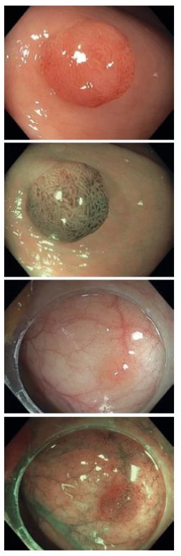 Diminutivní adenomy v bílém světle a v NBI, kategorie NICE II.
Fig. 2. Adenomas in a native examination and in NBI, NICE II category.