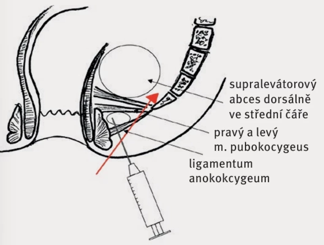  Diagnostická punkce hlubokého postanálního prostoru  u dorzálního supralevátorového abscesu. Červená šipka  znázorňuje nesprávný směr punkce.  Diagnostic puncture of the deep postanal space in dorsal  supralevator abscess. The red arrow shows the wrong  direction of the puncture.