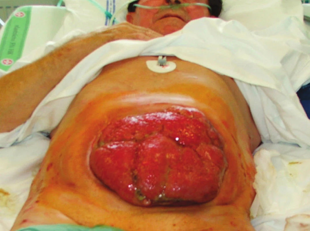 Situace 1 týden po rekonstrukční operaci GIT s ponechaným laparostomatem (pacient č. 9)
Fig. 3 The same patient 1 week after his GIT reconstruction procedure with laparostomy (patient No 9)
