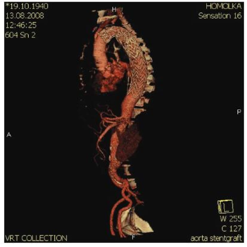 SG časně po operaci zcela komprimuje falešné lumen
Fig. 3. SG fully compromising the false lumen during early postoperative period