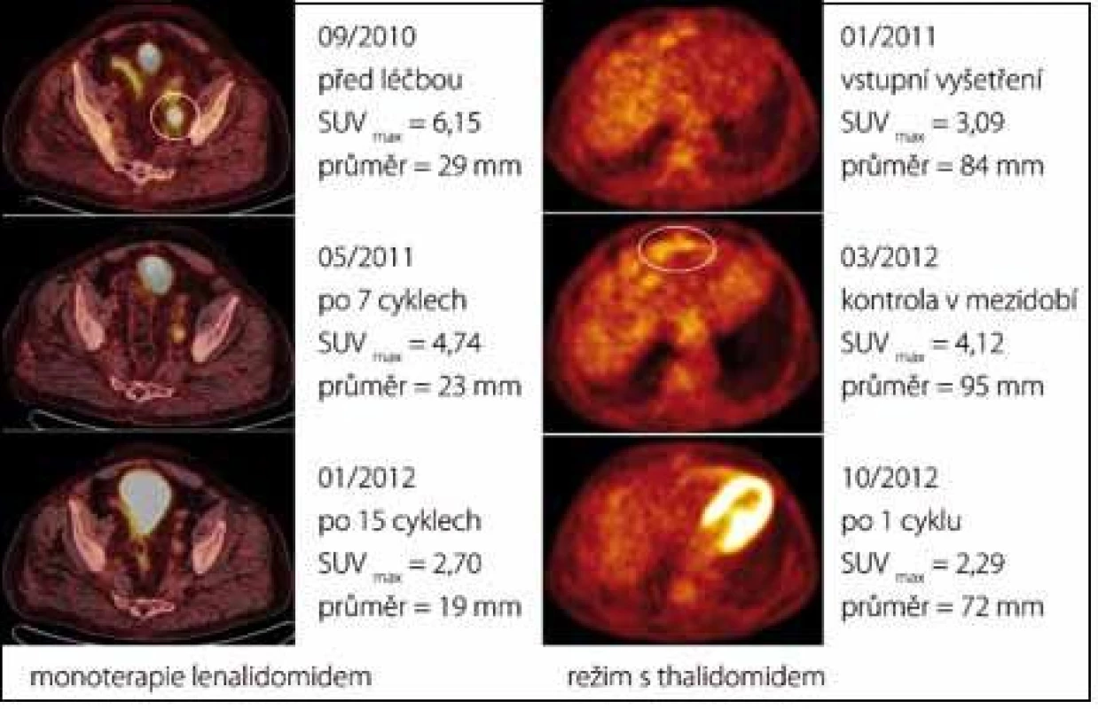 Prokazatelný léčebný účinek imunomodulancií u případu 3 (vlevo, PET /CT axiální řezy nad úrovní stropu levého acetabula) a případu 5 (vpravo, PET axiální řezy v úrovni bráničního úhlu ventrálně). Při léčbě lenalidomidem došlo k postupnému poklesu hypermetabolizmu radiofarmaka v patologické lézi až pod hranici detekce (po 15 cyklech). Léčba režimem s thalidomidem vedla k prudkému poklesu metabolické aktivity uzlinového 
paketu již po aplikaci prvního cyklu (obrázkem vpravo uprostřed demonstrujeme nárůst aktivity ložiska v období bez léčby).