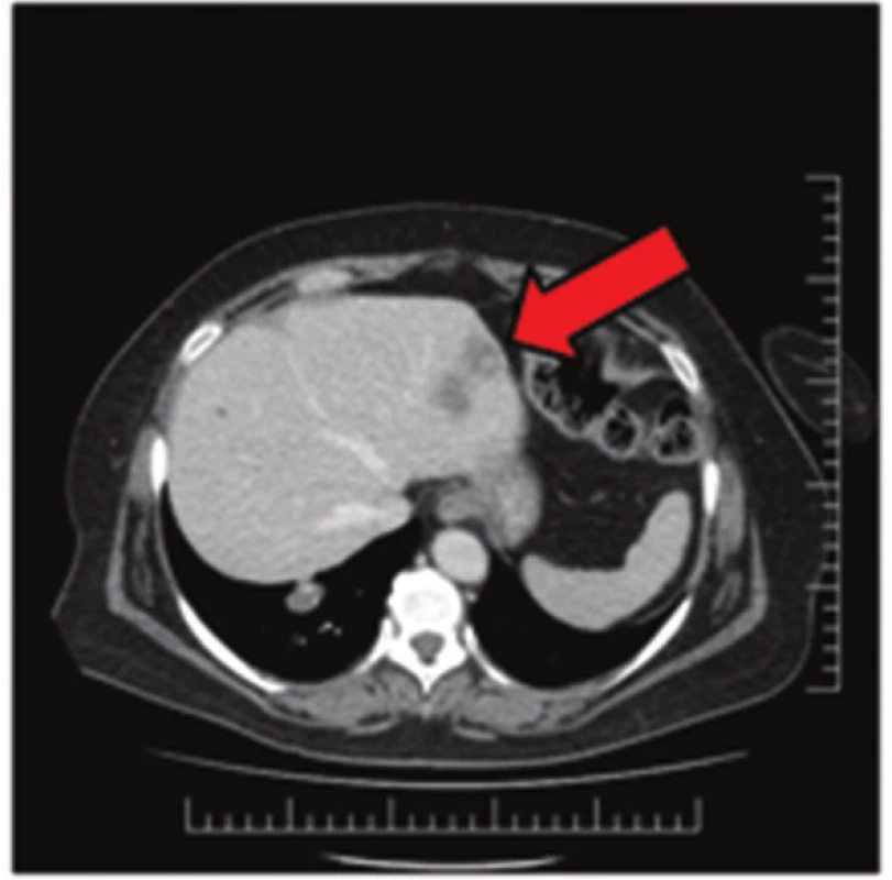 Jaterní metastázy na CT snímku
Fig. 1: Liver metastases on CT scan