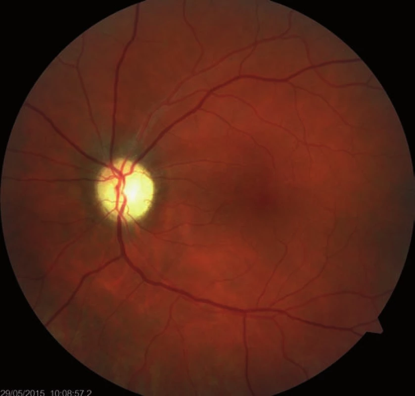 Regression of the optic nerve disc edema, two-month follow-up.