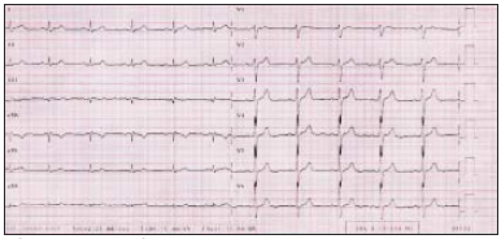 Elektrokardiografický záznam pacientky z roku 2001 získaný při běžné hematologické kontrole, subjektivně bez potíží.
