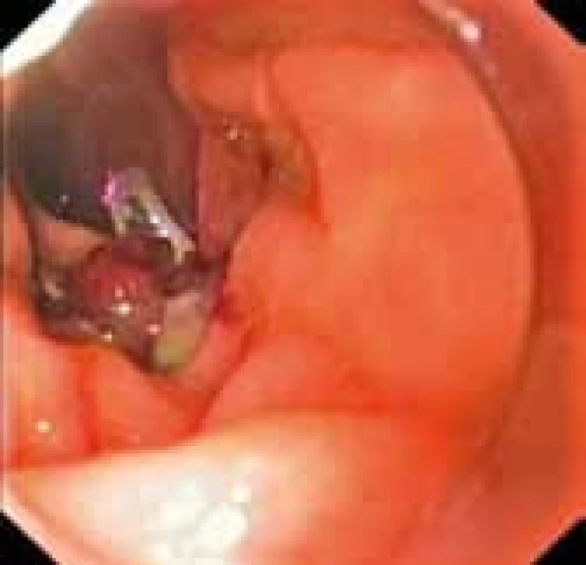 Zaklipovaná perforace stěny duodena pomocí OtSC.
Fig. 4. Clipped perforation of the duodenal wall using the OTSC.