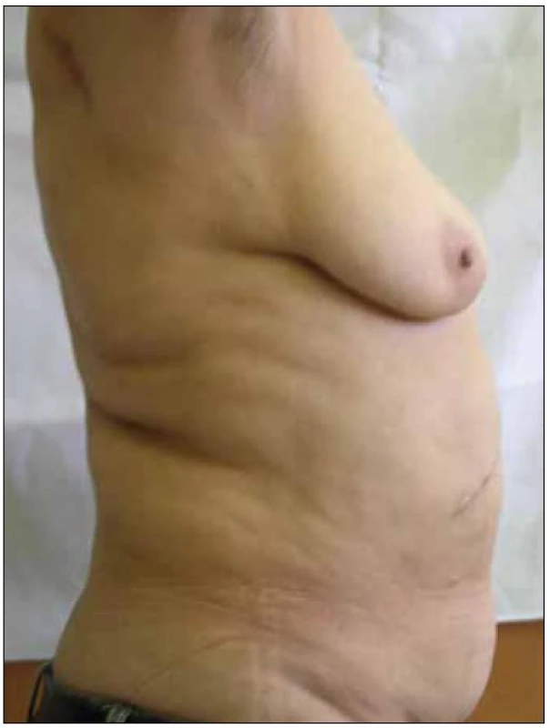 Lipohypertrofie – akumulace tuku v abdominální oblasti.