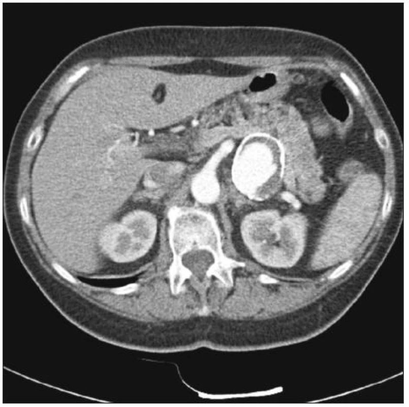 Aneuryzma slezinné tepny, CT-AG
Fig. 6. Aneurysm of the splenic artery, CT-AG