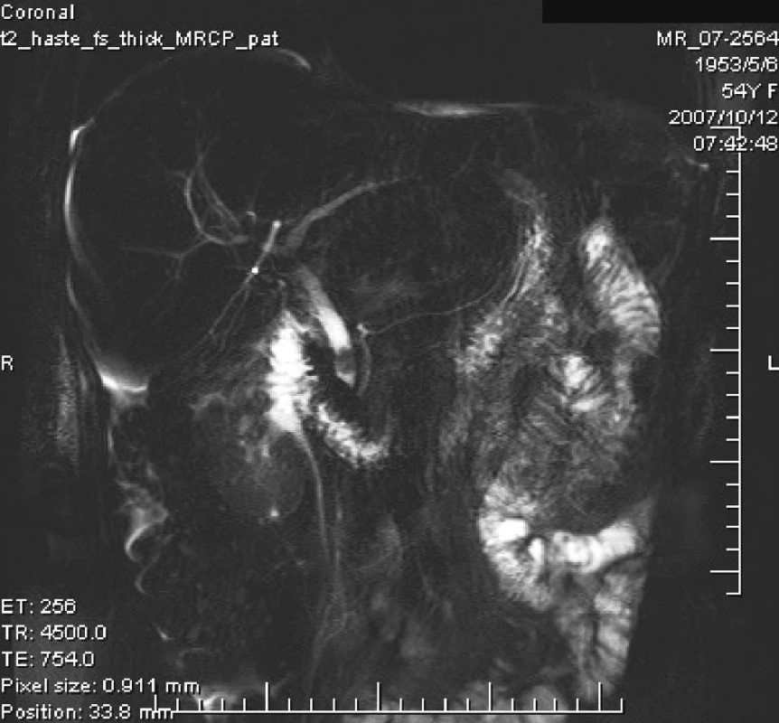 MRCP = choledocholit nad papilou
Fig. 9. MRCP = a choledocholith above the papilla