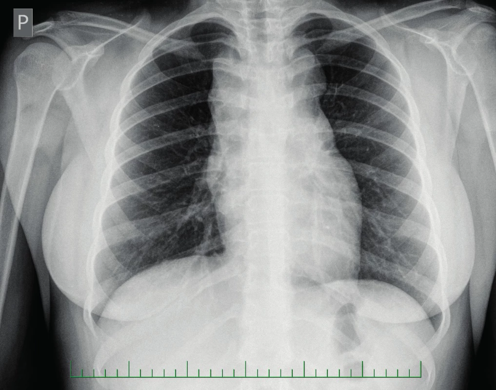 Rtg hrudníku – rozšířené horní mediastinum.
Fig. 1. Chest X-ray – widened superior mediastinum.