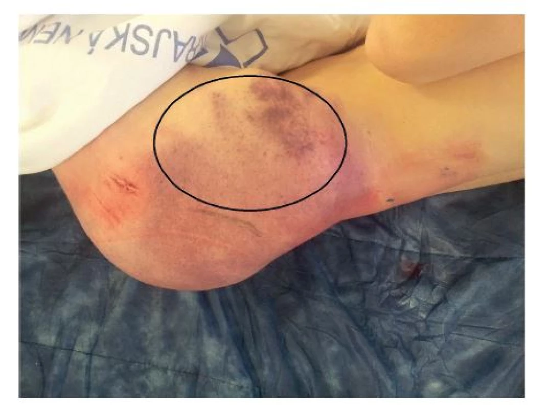 Obr. 1: Rozsáhlá podlitina (“cucflek“) v oblasti hýždě s elastickou rezistencí vlevo
Fig. 1: Large sufusion (“lovebite“) of gluteal area with elastic swelling
