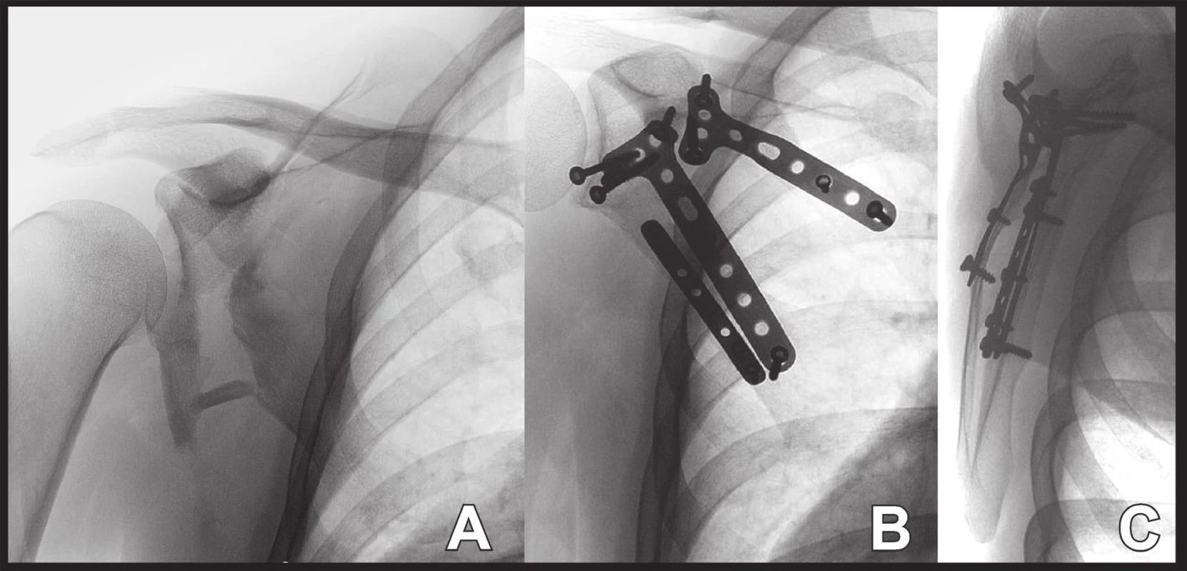 Osteosyntéza zlomeniny dolního glenoidu a těla lopatky: A – situace po úrazu; B+C – situace po operaci.
Fig. 10: Internal fixation of fractures of inferior glenoid and scapular body: A – post-injury radiograph; B+C – postoperative radiograph.