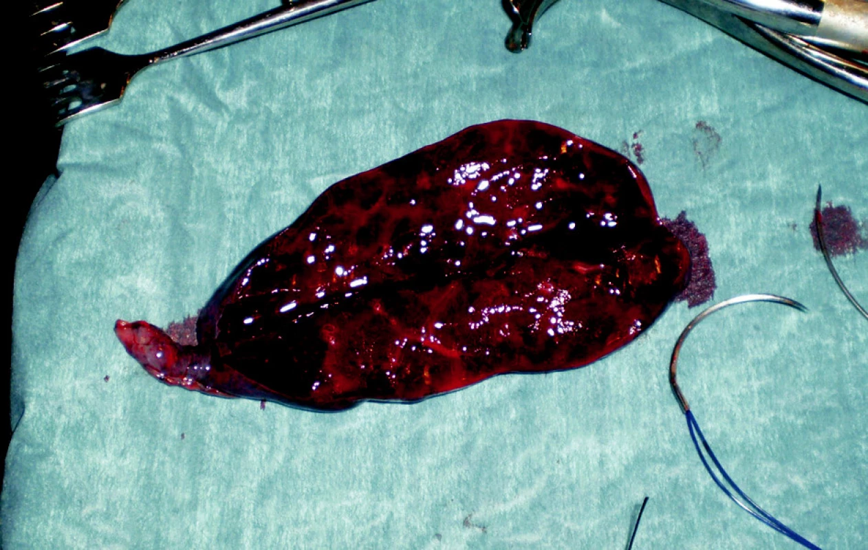 Resekát postižené části levé plíce
Fig. 4. Resected part of the affected left lung