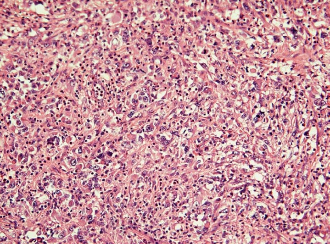 Histiocytární sarkom sleziny (hematoxylin-eozin). Nádorový infiltrát tvoří polymorfní buňky histiocytárního typu s mitotickou aktivitou. Jádra nádorových buněk jsou vezikulární se zřetelnými nukleoly, cytoplazma je poměrně objemná, eozinofilní. Reaktivní pozadí infiltrátu tvoří malé lymfocyty, nenádorové histiocyty, eozinofily a neutrofily.