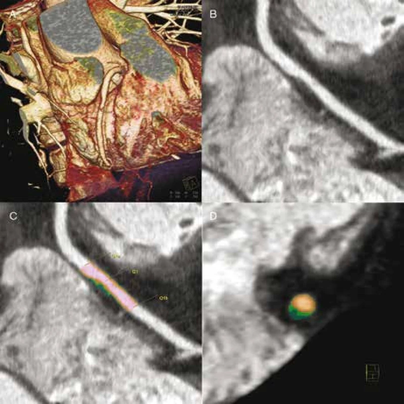 CT angiografie: „měkký“ plát způsobující hemodynamicky nevýznamnou stenózu ACD (A), který obsahuje poměrně významné lipoidní jádro (B). Jedná se tedy o vysoce rizikový cholesterolový plát. Charakter plátu je patrný při cílené analýze i (C, D – lipoidní jádro tmavě zelené).