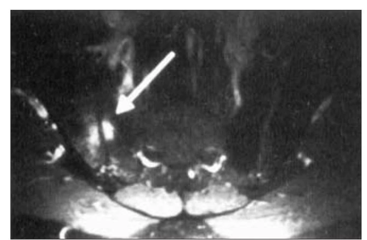 Sakroiliitida na MRI, kostní hyperemie a edém.