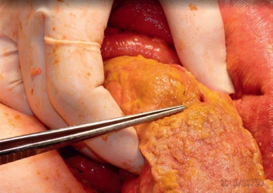 Resekát s píštělí po perforaci divertiklu. Bowel resection with fibrotic diverticular fistula.