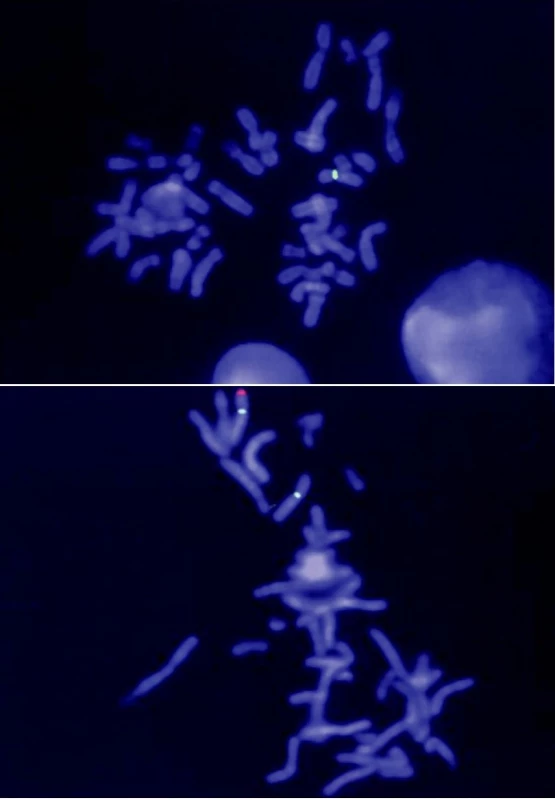 Molekulárně cytogenetická analýza mikrodelece chromozomu Xp22.3 v lokusu STS metodou FISH. 
Pro vyšetření X-vázané ichtyózy má význam především sonda, která hybridizuje s lokusem STS, jehož delece je za vznik choroby zodpovědná. Sonda je dlouhá 220 kb a značena fluorescenčním barvivem Spectrum Orange (červený signál). Mikrodelece kritického regionu se projeví absencí signálu v oblasti Xp22.3. Při hybridizaci je současně každý chromozom X označen další (tzv. kontrolní) sondou, která slouží pouze k detekci přítomnosti chromozomu X, popř. k vyloučení některých strukturních přestaveb tohoto chromozomu (zelený signál). A) Výsledek vyšetření probanda (červený signál na chromozomu X chybí). B) Výsledek vyšetření matky probanda (červený signál je přítomen pouze na jednom chromozomu X, druhý chromozom X je deletován)