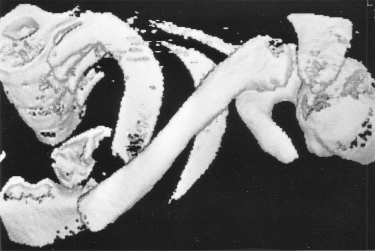 3D CT rekonstrukce šikmé extraartikulární zlomeniny mediálního klíčku vlevo
Fig. 4. 3D CT reconstruction of the oblique extra-articular fracture of the medial end of the left clavicle