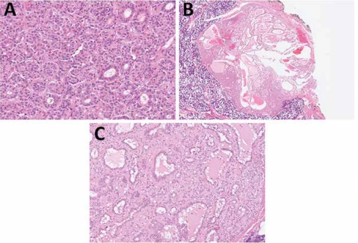 Adenom z buněk žíhaných vývodů/striated duct adenoma je vzácný monofázický benigní nádor složený z duktálních nádorových buněk připomínajícím normální epitelie žíhaného vývodu.