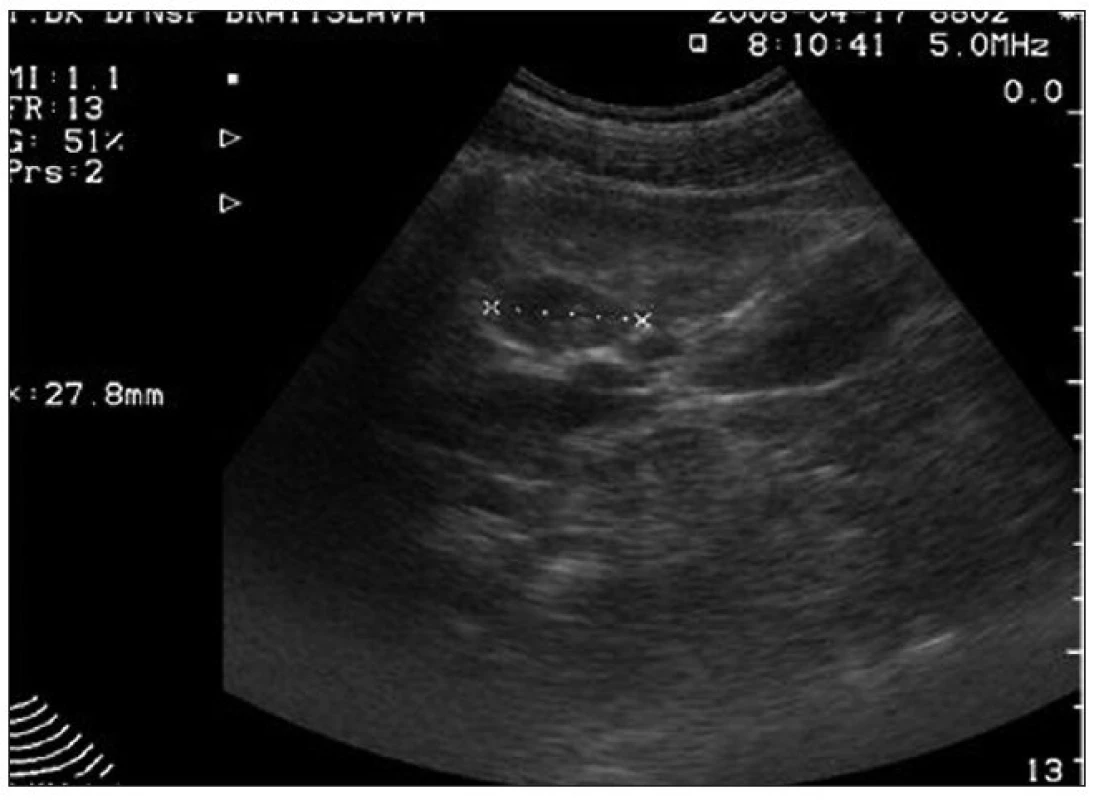 USG vyšetrenie po 16 dňoch: pretrváva len jedno hypoechogénne ložisko v pravej obličke.
Fig. 4. USG imaging after 16 days: only one hypoechogenic focus in the right kidney still remains.