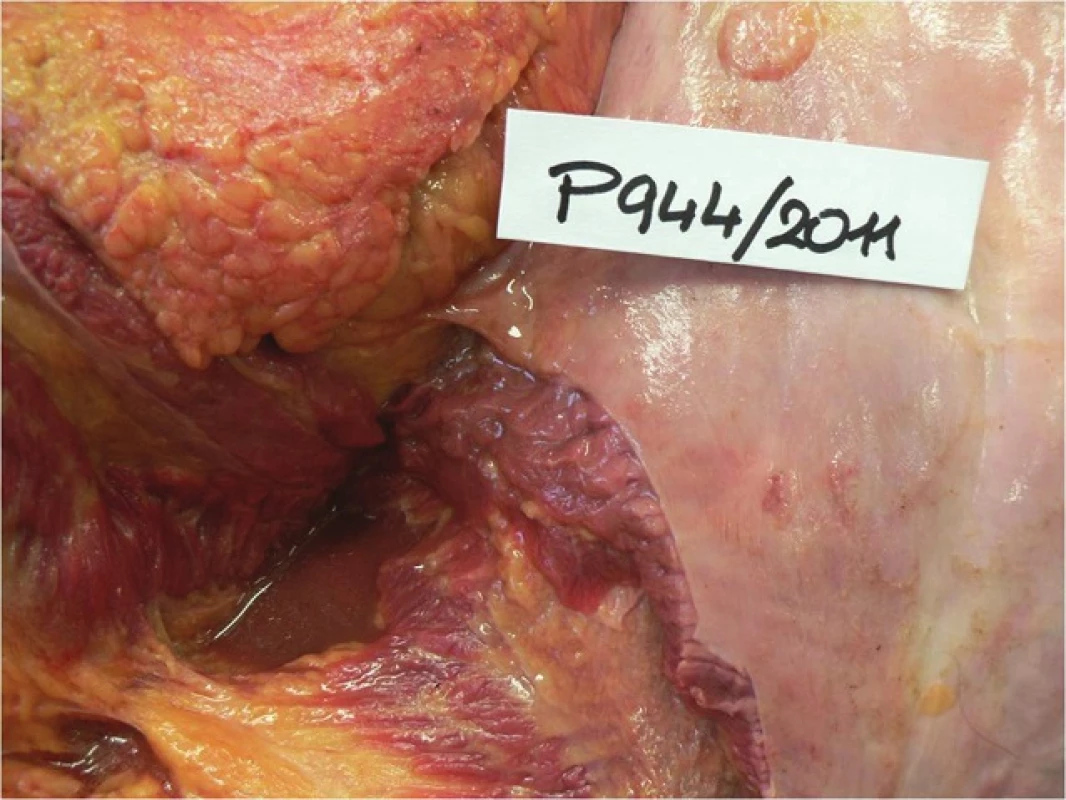 Perforační otvor na žaludku
Fig. 1: Point of gastric perforation