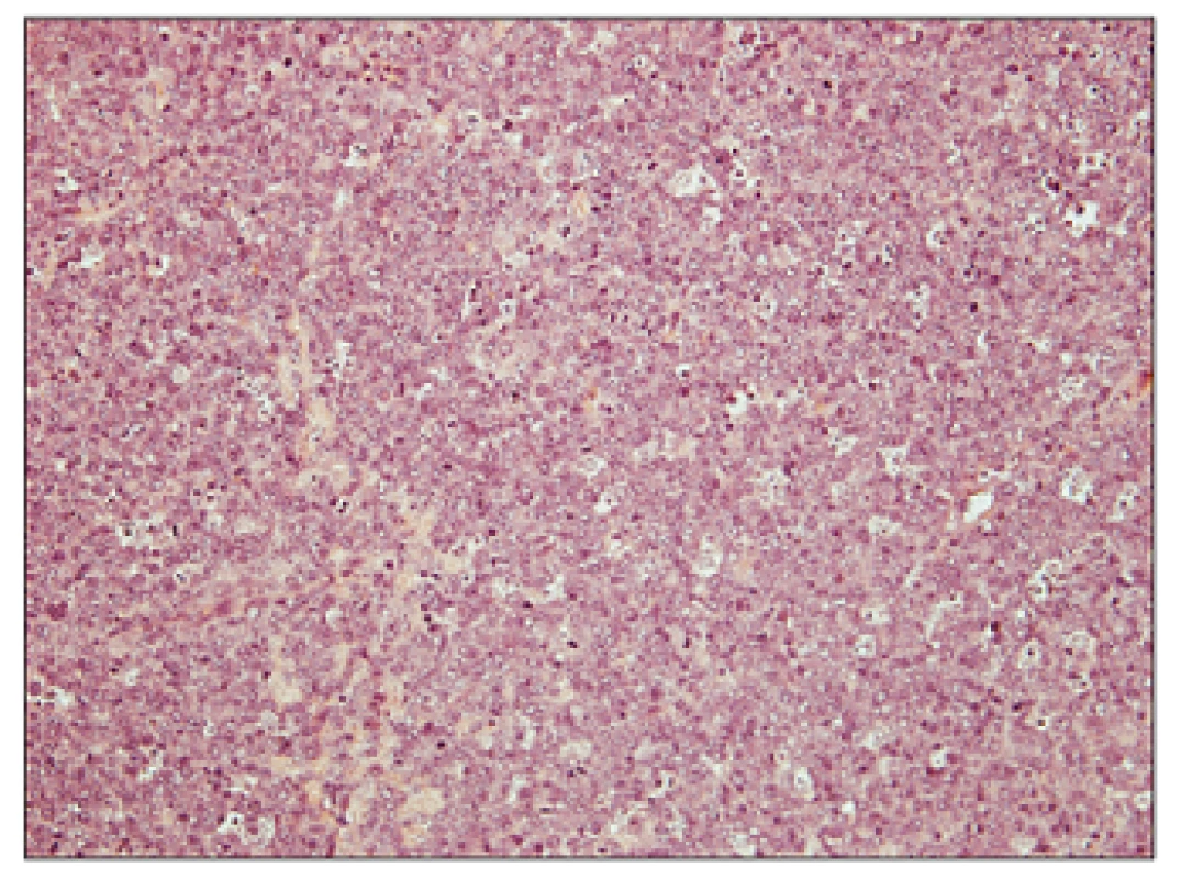 Folikulární lymfom transformovaný do DLBCL, hematoxylin – eosin, zvětšení 200x.