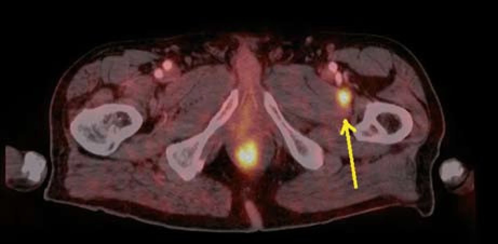 PET CT – zvýšená akumulace FDG v adduktoru levého stehna – metastáza melanomu.
Fig. 11. PET CT – higher FDG accummulation in left adductor – melanoma metastasis.
