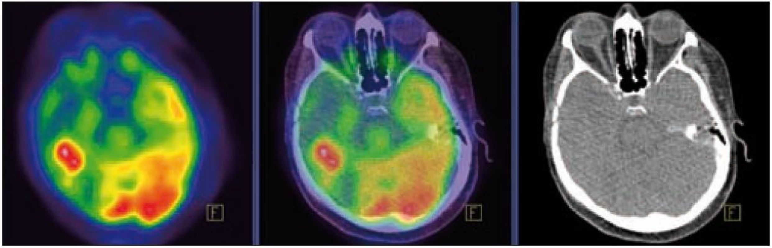 PET – Low-dose CT mozku. Ložisko vyšší akumulace FDG temporálně vpravo, SUV<sub>max</sub> 12,53. Relativně nižší akumulace radiofarmaka v okolní kůře temporálního laloku vpravo.