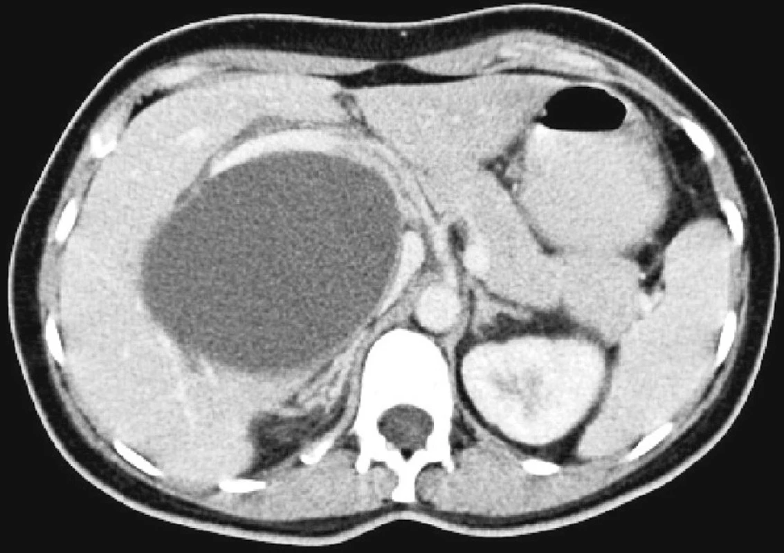 CT břicha s kontrastní látkou i.v. v portální fázi. Objemný cystický útvar odtlačující a komprimující v. portae a DDŽ.
Fig. 1. Contrast abdominal CT scan with the i.v. contrast matter in the portal phase. Major cystic body displacing and compessing the portal vein and the inferior vena cava (DDŽ).
