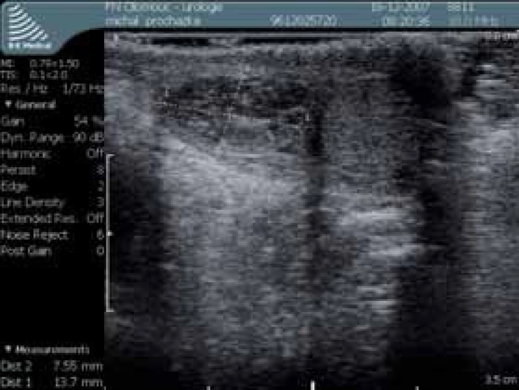 Sonografický nález útvaru při horním pólu varlete (B mode)
Fig. 1. Sonographic finding of formation at upper pole of testicle (B mode)