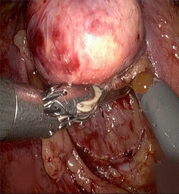 Resekce s otevřením dutého systému.  Fig. 2. Resection with opening renal collecting system. 